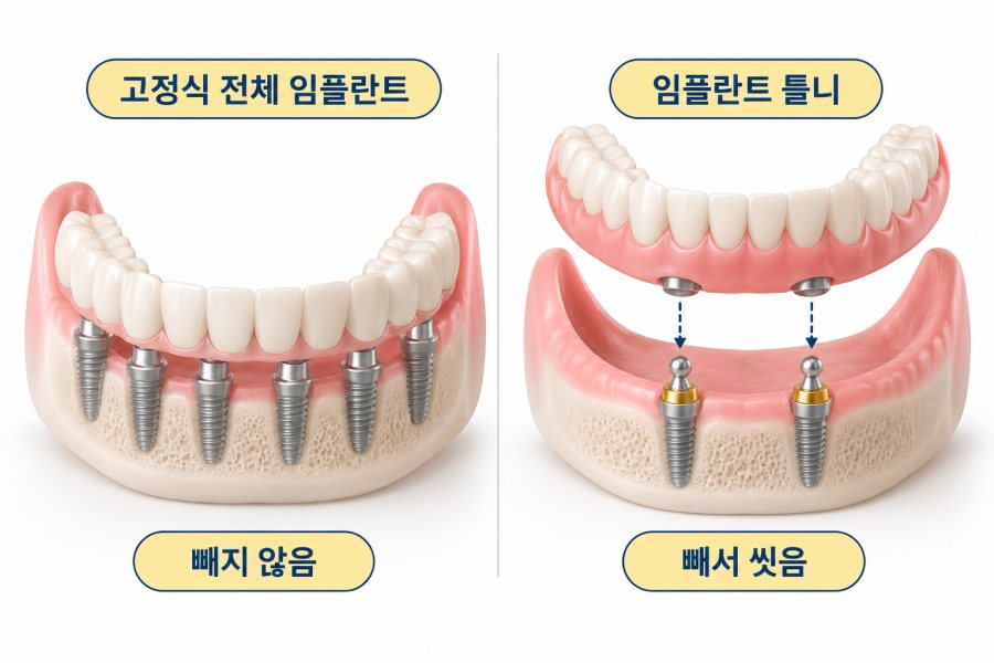 고정식 전체 임플란트와 임플란트 틀니 구조 비교