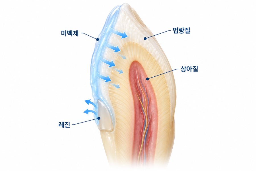 미백제 자연치아와 레진 차이